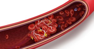 CHLA-Blog-Prevent-Recognize-Blood-Clot-02